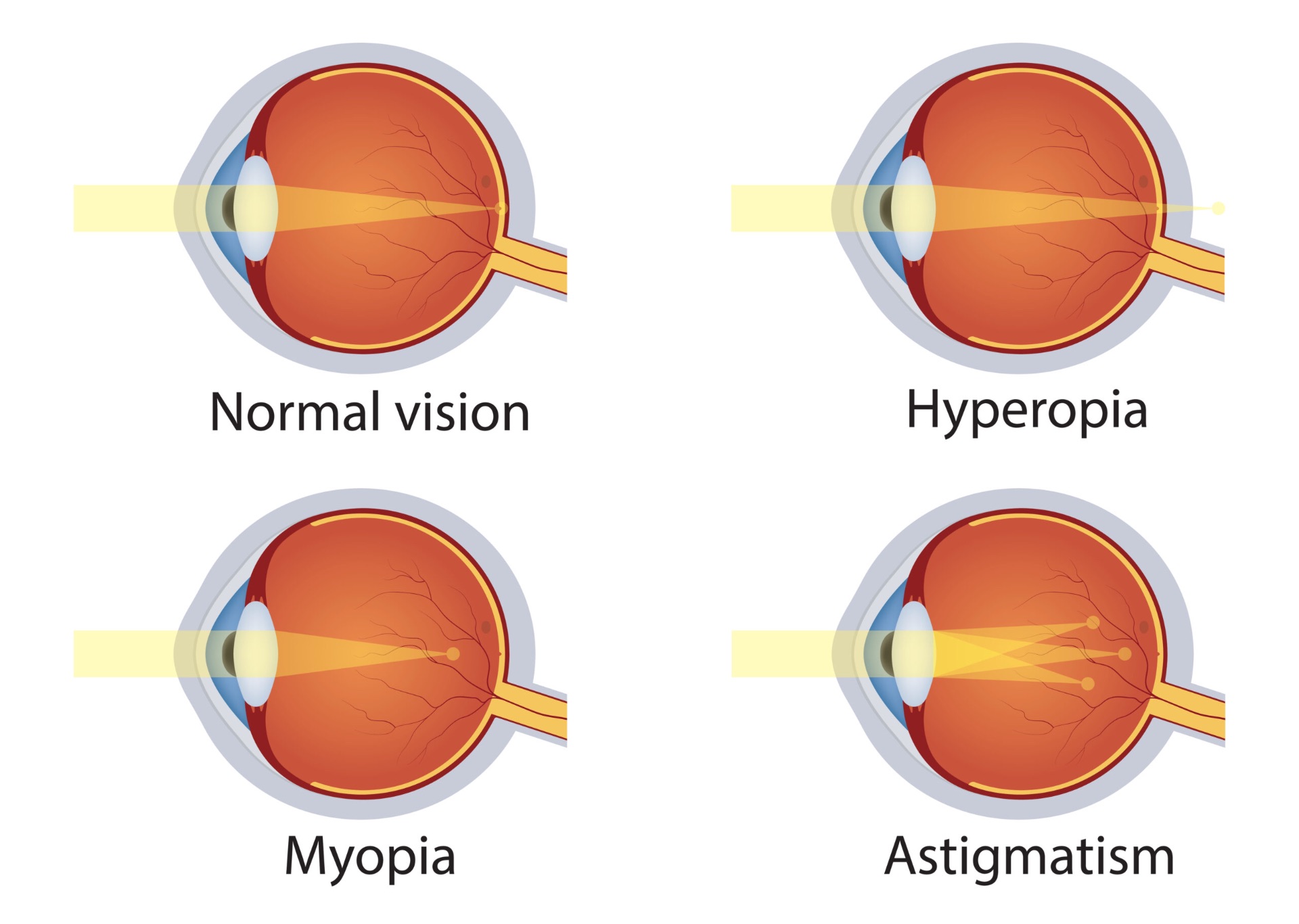 Illustration: Refractive Errors